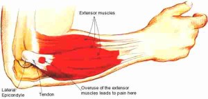 Tennis Elbow