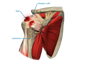 rotator cuff tear