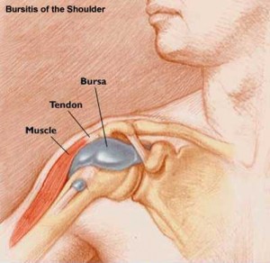 Subacromial-bursitis