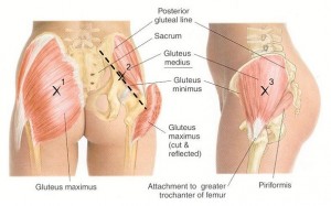 gluteal-tendinopathy-1