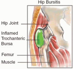 hip bursitis