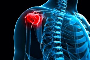 shoulder-bursitis