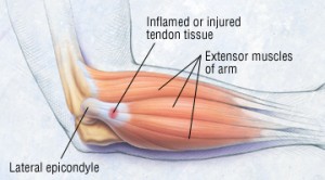 tendonitis