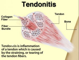 tennis elbow cure