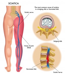 sciatic-pain