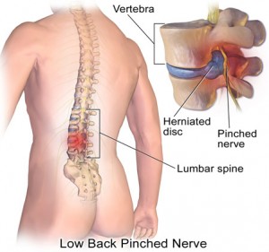 sciatica-pain