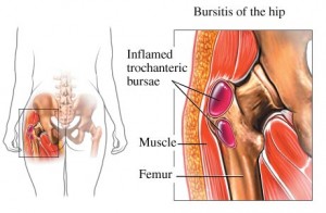 Hip_Bursitis