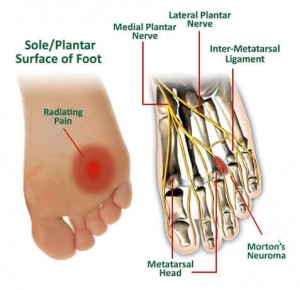 Mortons Neuroma