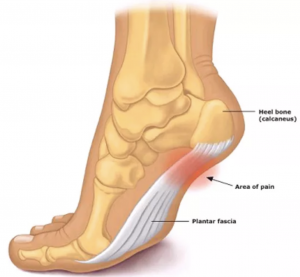 Heel Pain