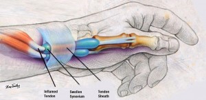 DeQuervain-tendinopathy